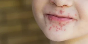 Waspadai Flu Singapura Serang Anak Usia 5 – 10 Tahun, Cermati Penyebab hingga Pencegahannya