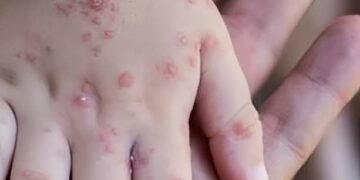 Penyebaran Flu Singapura di Batang: Ringan Tapi Menular